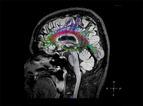 3テスラMRI